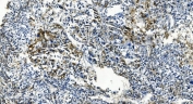 IHC staining of FFPE human liver cancer with TMBIM1 antibody. HIER: boil tissue sections in pH8 EDTA for 20 min and allow to cool before testing.