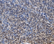 IHC staining of FFPE human skin cancer with CDC27 antibody. HIER: boil tissue sections in pH8 EDTA for 20 min and allow to cool before testing.