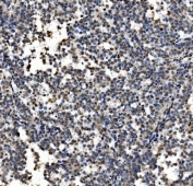 IHC staining of FFPE human melanoma with CDC27 antibody. HIER: boil tissue sections in pH8 EDTA for 20 min and allow to cool before testing.