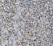 IHC staining of FFPE human gastric cancer with CDC27 antibody. HIER: boil tissue sections in pH8 EDTA for 20 min and allow to cool before testing.