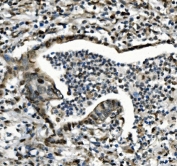IHC staining of FFPE human rectal cancer with CDC27 antibody. HIER: boil tissue sections in pH8 EDTA for 20 min and allow to cool before testing.