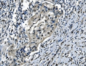 IHC staining of FFPE human bladder cancer with CDC27 antibody. HIER: boil tissue sections in pH8 EDTA for 20 min and allow to cool before testing.