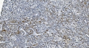 IHC staining of FFPE human liver cancer with Diacylglycerol kinase zeta antibody. HIER: boil tissue sections in pH8 EDTA for 20 min and allow to cool before testing.