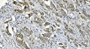 IHC staining of FFPE human breast cancer with Diacylglycerol kinase zeta antibody. HIER: boil tissue sections in pH8 EDTA for 20 min and allow to cool before testing.