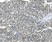 IHC staining of FFPE human testicular cancer with Glycine decarboxylase antibody. HIER: boil tissue sections in pH8 EDTA for 20 min and allow to cool before testing.