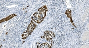 IHC staining of FFPE human bladder cancer with Glycine decarboxylase antibody. HIER: boil tissue sections in pH8 EDTA for 20 min and allow to cool before testing.