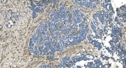IHC staining of FFPE human ovarian cancer with GNG2 antibody. HIER: boil tissue sections in pH8 EDTA for 20 min and allow to cool before testing.