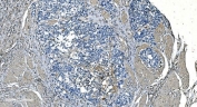 IHC staining of FFPE human bladder cancer with GNG2 antibody. HIER: boil tissue sections in pH8 EDTA for 20 min and allow to cool before testing.
