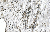 IHC staining of FFPE human melanoma with GNG4 antibody. HIER: boil tissue sections in pH8 EDTA for 20 min and allow to cool before testing.