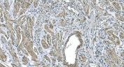 IHC staining of FFPE human renal carcinoma with GNG4 antibody. HIER: boil tissue sections in pH8 EDTA for 20 min and allow to cool before testing.