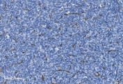 IHC staining of FFPE human skin cancer with GNG11 antibody. HIER: boil tissue sections in pH8 EDTA for 20 min and allow to cool before testing.