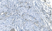 IHC staining of FFPE human renal carcinoma with GNG11 antibody. HIER: boil tissue sections in pH8 EDTA for 20 min and allow to cool before testing.