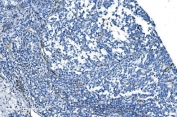 IHC staining of FFPE human melanoma with GNG11 antibody. HIER: boil tissue sections in pH8 EDTA for 20 min and allow to cool before testing.