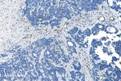 IHC staining of FFPE human ovarian cancer with GNG11 antibody. HIER: boil tissue sections in pH8 EDTA for 20 min and allow to cool before testing.