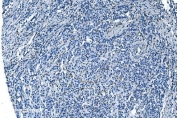 IHC staining of FFPE human gastric cancer with GNG11 antibody. HIER: boil tissue sections in pH8 EDTA for 20 min and allow to cool before testing.