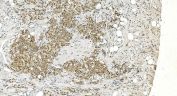 IHC staining of FFPE human renal carcinoma with LSM5 antibody. HIER: boil tissue sections in pH8 EDTA for 20 min and allow to cool before testing.