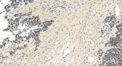 IHC staining of FFPE human ovarian cancer with LSM5 antibody. HIER: boil tissue sections in pH8 EDTA for 20 min and allow to cool before testing.