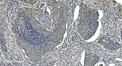 IHC staining of FFPE human lung cancer with LSM5 antibody. HIER: boil tissue sections in pH8 EDTA for 20 min and allow to cool before testing.