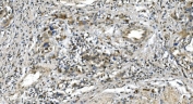 IHC staining of FFPE human bladder cancer with LSM5 antibody. HIER: boil tissue sections in pH8 EDTA for 20 min and allow to cool before testing.