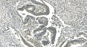 IHC staining of FFPE human rectal cancer with LSM5 antibody. HIER: boil tissue sections in pH8 EDTA for 20 min and allow to cool before testing.