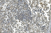 IHC staining of FFPE human melanoma with LSM7 antibody. HIER: boil tissue sections in pH8 EDTA for 20 min and allow to cool before testing.