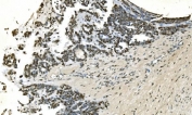 IHC staining of FFPE human ovarian cancer with LSM7 antibody. HIER: boil tissue sections in pH8 EDTA for 20 min and allow to cool before testing.