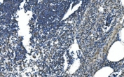 IHC staining of FFPE human appendicitis tissue with LSM7 antibody. HIER: boil tissue sections in pH8 EDTA for 20 min and allow to cool before testing.