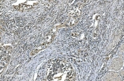 IHC staining of FFPE human bladder cancer with LSM7 antibody. HIER: boil tissue sections in pH8 EDTA for 20 min and allow to cool before testing.