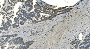 IHC staining of FFPE human ovarian cancer with LSM8 antibody. HIER: boil tissue sections in pH8 EDTA for 20 min and allow to cool before testing.
