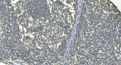 IHC staining of FFPE human melanoma tissue with LSM8 antibody. HIER: boil tissue sections in pH8 EDTA for 20 min and allow to cool before testing.