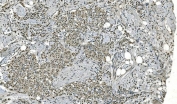 IHC staining of FFPE human renal carcinoma with LSM8 antibody. HIER: boil tissue sections in pH8 EDTA for 20 min and allow to cool before testing.