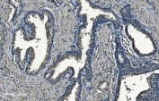 IHC staining of FFPE human prostate cancer with NDUFB5 antibody. HIER: boil tissue sections in pH8 EDTA for 20 min and allow to cool before testing.