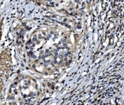IHC staining of FFPE human bladder cancer with OTULIN antibody. HIER: boil tissue sections in pH8 EDTA for 20 min and allow to cool before testing.