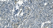 IHC staining of FFPE human bladder cancer with PI16 antibody. HIER: boil tissue sections in pH8 EDTA for 20 min and allow to cool before testing.