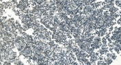 IHC staining of FFPE human testicular cancer with PI16 antibody. HIER: boil tissue sections in pH8 EDTA for 20 min and allow to cool before testing.