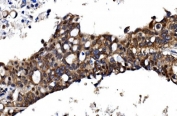 IHC staining of FFPE human pancreatic cancer with TBP-1 antibody. HIER: boil tissue sections in pH8 EDTA for 20 min and allow to cool before testing.