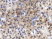 IHC staining of FFPE human renal carcinoma with TBP-1 antibody. HIER: boil tissue sections in pH8 EDTA for 20 min and allow to cool before testing.