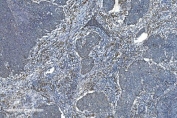 IHC staining of FFPE human lung cancer with TIMM8A antibody. HIER: boil tissue sections in pH8 EDTA for 20 min and allow to cool before testing.