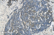 IHC staining of FFPE human ovarian cancer with TIMM8A antibody. HIER: boil tissue sections in pH8 EDTA for 20 min and allow to cool before testing.