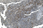 IHC staining of FFPE human testicular cancer with TIMM8A antibody. HIER: boil tissue sections in pH8 EDTA for 20 min and allow to cool before testing.