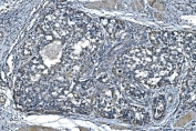 IHC staining of FFPE human bladder cancer with TIMM8A antibody. HIER: boil tissue sections in pH8 EDTA for 20 min and allow to cool before testing.