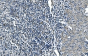 IHC staining of FFPE human gastric cancer with TIMM8A antibody. HIER: boil tissue sections in pH8 EDTA for 20 min and allow to cool before testing.