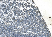 IHC staining of FFPE human melanoma with TIMM8A antibody. HIER: boil tissue sections in pH8 EDTA for 20 min and allow to cool before testing.