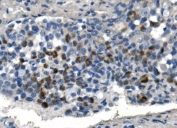 IHC staining of FFPE human gastric cancer with TMPRSS3 antibody. HIER: boil tissue sections in pH8 EDTA for 20 min and allow to cool before testing.