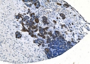 IHC staining of FFPE human ovarian cancer with TMPRSS3 antibody. HIER: boil tissue sections in pH8 EDTA for 20 min and allow to cool before testing.