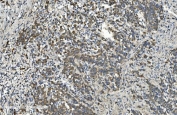 IHC staining of FFPE human gastric cancer with gp91phox antibody. HIER: boil tissue sections in pH8 EDTA for 20 min and allow to cool before testing.