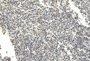 IHC staining of FFPE human testicular cancer with gp91phox antibody. HIER: boil tissue sections in pH8 EDTA for 20 min and allow to cool before testing.
