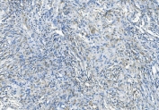 IHC staining of FFPE human meningioma tissue with DNAJC6 antibody. HIER: boil tissue sections in pH8 EDTA for 20 min and allow to cool before testing.