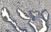 IHC staining of FFPE human prostate cancer with DNAJC10 antibody. HIER: boil tissue sections in pH8 EDTA for 20 min and allow to cool before testing.