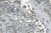 IHC staining of FFPE human breast cancer with DNAJC10 antibody. HIER: boil tissue sections in pH8 EDTA for 20 min and allow to cool before testing.